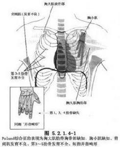 胸大肌無發育並短指綜合徵胸壁缺損修復術 胸大肌無發育並短指綜合徵胸壁缺損修復術
