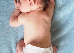 新生兒低鈉血症