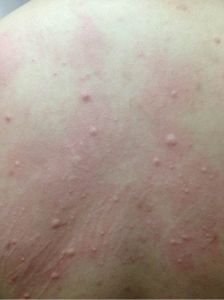 膽鹼能性蕁麻疹 膽鹼能性蕁麻疹