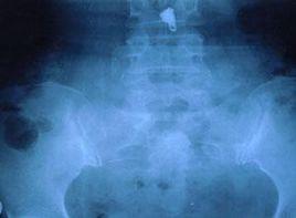 骶骨處持續性疼痛 骶骨處持續性疼痛