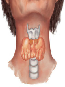 亞急性甲狀腺炎 亞急性甲狀腺炎
