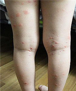 血清病型反應 血清病型反應