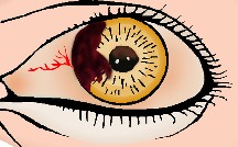 （圖）血不循經目(前房有血塊)