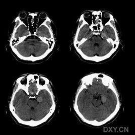 腦CT 腦CT