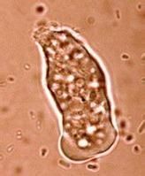 腸外阿米巴病 腸外阿米巴病