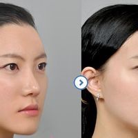 下顎骨關節炎 下顎骨關節炎