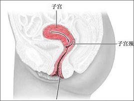子宮頸原位癌累及腺體