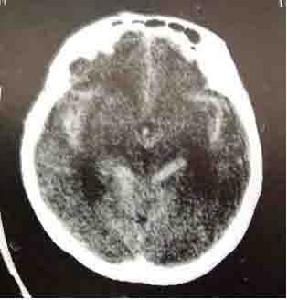 自發性蛛網膜下隙出血 自發性蛛網膜下隙出血