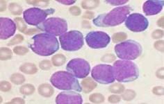 癌性發熱 癌性發熱