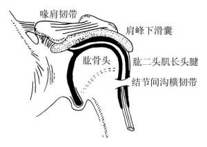 肱二頭肌長頭肌腱腱鞘炎 肱二頭肌長頭肌腱腱鞘炎