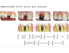 種牙流程圖