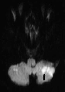 橋腦基底內側綜合徵