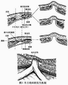 半月線疝 圖3