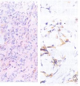 慢性間質性腎炎