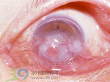 暴露性角膜炎 暴露性角膜炎