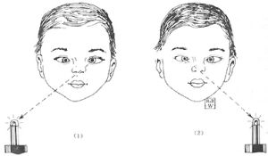 先天性內斜視 先天性內斜視