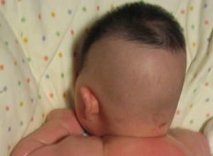 嬰兒枕禿 嬰兒枕禿