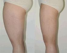 360&deg;環形吸脂