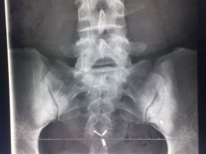 緻密性骨炎 緻密性骨炎