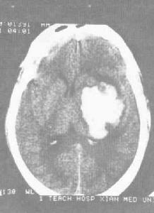 高血壓性腦出血