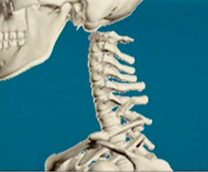 頸椎雙側關節突關節脫位