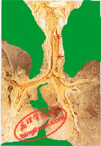 圖7 氣管白喉（假膜形成）