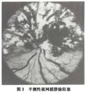 視網膜靜脈阻塞