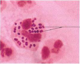腦膜炎奈瑟菌 腦膜炎奈瑟菌