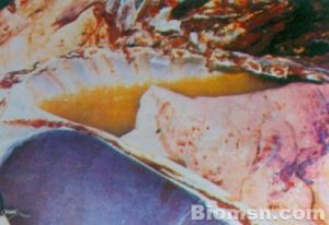 急性滲出性胸膜炎