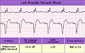 左束支傳導阻滯