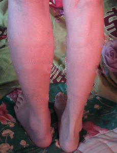 下肢深靜脈血栓 下肢深靜脈血栓