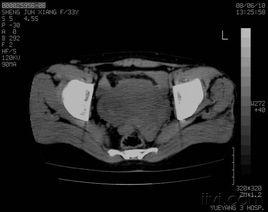 盆底病變 盆底病變