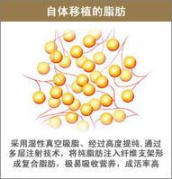 自脂無痕隆胸術