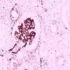 紅斑狼瘡腎炎 紅斑狼瘡腎炎