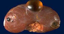 軟堅散結療法 軟堅散結療法