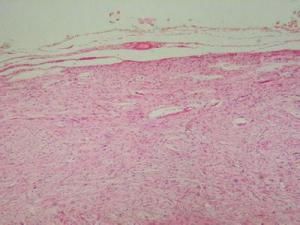 假膜性小腸結腸炎 假膜性小腸結腸炎