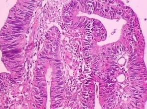 結腸腺癌 結腸腺癌