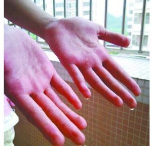 女孩患手汗症雙手流汗不止13年