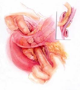 先天性十二指腸閉鎖