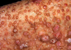 大皰性表皮鬆解症