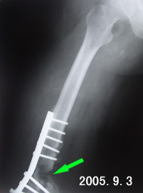 股骨髁部骨折 股骨髁部骨折