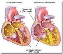心房纖顫 心房纖顫