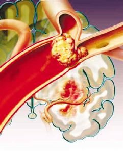  老年急性心肌梗死病理圖 