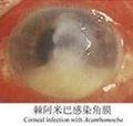 棘阿米巴性角膜炎 棘阿米巴性角膜炎