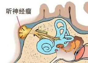 位聽神經 位聽神經
