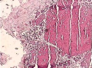 鼻真菌病 鼻真菌病