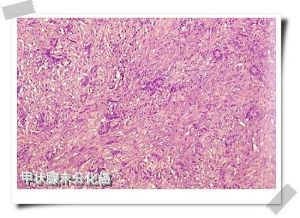 甲狀腺未分化癌 甲狀腺未分化癌