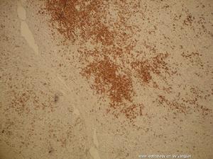 愛滋病性頸淋巴結腫大