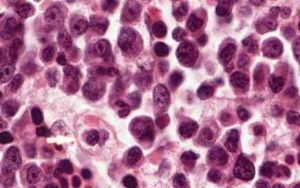 噬血細胞綜合徵——淋巴增生