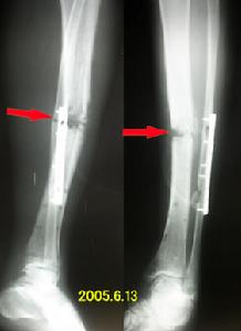 脛腓骨骨折 脛腓骨骨折